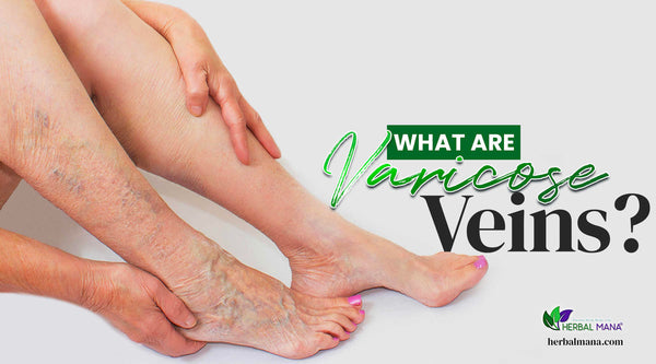 What are Varicose Veins person with spider veins in their leg holding their heel close up white background green and black text